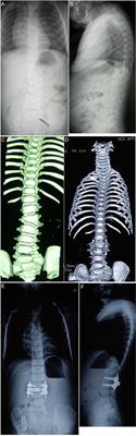 Comparison of the Curative Efficacy of Hemivertebra Resection via the Posterior Approach Assisted With Unilateral and Bilateral Internal Fixation in the Treatment of Congenital Scoliosis